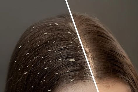 Hair Lice, Lice Removal, Hair Facts, Rapid Hair Growth, Head Louse, Petroleum Jelly, Cap Hair, Natural Home Remedies, Natural Home