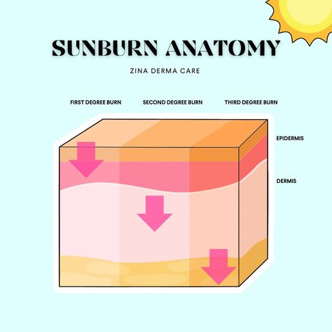 🌞☀️🔥 Sunburn Anatomy 🔥☀️🌞 Summer is here, and while we all love soaking up the sun, it’s important to understand the different degrees of sunburn and the layers of our skin that are affected. 🔥 First Degree Burn: This is the mildest form of sunburn, affecting the outermost layer of the skin called the epidermis. It usually appears as redness, mild pain, and slight peeling. Remember to apply sunscreen to avoid this! 🔥 Second Degree Burn: A more severe sunburn that extends beyond the epiderm... First Degree Burn, Second Degree Burn, Tech Room Ideas, Severe Sunburn, Tech Room, Degree Burns, Summer Is Here, Love Is All, Sunscreen