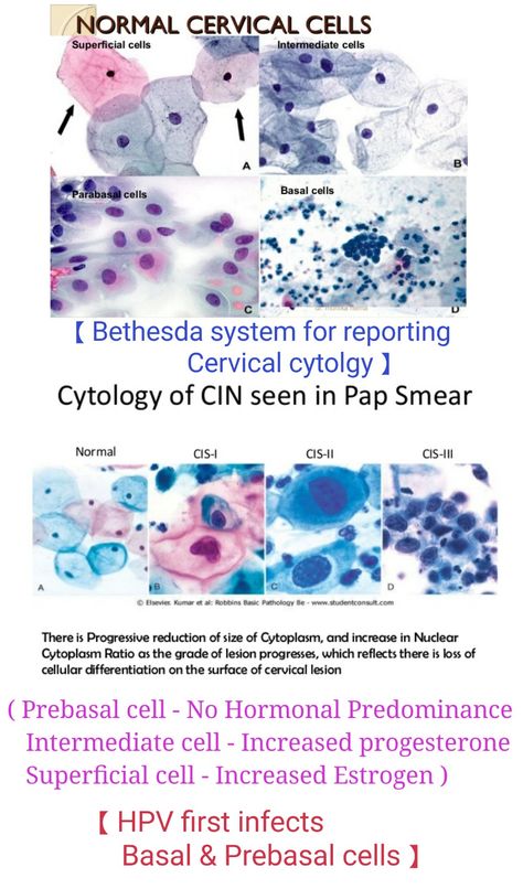 Cervical cytology - Normal & Abnormal 【 Note : Increase Nucleus cytoplasmic ratio & loss of differentiation in CIN 】#cervix Cytology Notes, Histology Slides, Medical Laboratory Scientist, Basal Cell, Medicine Notes, Squamous Cell, Tissue Types, Cell Biology, Medical Studies