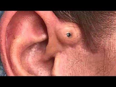 Big Nasty Ear Blackheads!  Dilated Pores of Winer Extravaganza Ear Blackheads, Neck Pimples, Black Heads Removal Video, Huge Pimple, Ear Pimple, Squeezing Blackheads, Tonsil Stone, Blackheads On Face, Big Pimple