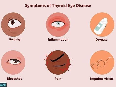 Thyroid Eye Disease, Low Thyroid Remedies, Bags Under Eyes, Thyroid Remedies, Thyroid Levels, Low Thyroid, Thyroid Symptoms, Hashimotos Disease, Graves Disease