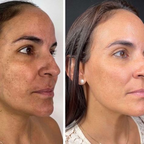 Mandelic Acid Peel: Benefits, Safety, Costs & Side Effects Skincare Acids, Chemical Peel At Home, Glycolic Acid Peel, Post Inflammatory Hyperpigmentation, Acid Peel, Uneven Skin Texture, Mandelic Acid, Skin Resurfacing, Peeling Skin