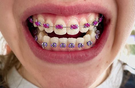 Braces Patterns, Braces Combos, Braces Color Combos, Purple Braces, Braces Colours, Braces Ideas, Shiny Teeth, Braces Smile, After Braces