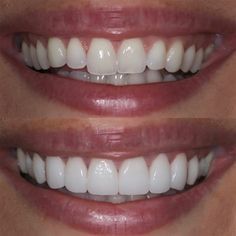 Teeth Makeover, Pretty Teeth, Veneers Teeth, Beautiful Teeth, Loose Tooth, Porcelain Veneers, Perfect Teeth, Teeth Shape, Dental Veneers