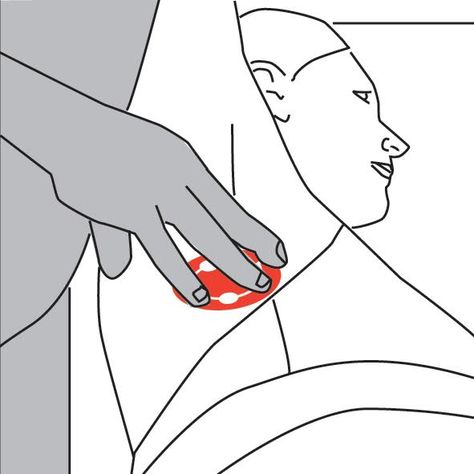 Serratus anterior muscle is multipennate - that means it has several heads (or insertions) into the ribs and hence can have several trigger points simultaneously. It rotates scapula (shoulder blade) for abduction and flexion of arm. It also protracts scapula (pulls it forward on chest wall and holds it closely to chest wall), facilitating pushing movements such as push-ups or punching. Serratus anterior trigger points respond very well to hands-on treatments, self help balls and stretching. Serratus Anterior Muscle, Winged Scapula, Serratus Anterior, Rib Pain, Trigger Point Release, Nerve Problems, Referred Pain, Muscle Knots, Chronic Cough