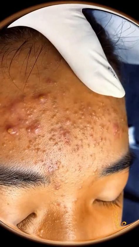 pimples popping video blackhead removal Pimple Poppìng Videos, Pimple Poppìng, Hair Growth For Women, Pimple Pop, How To Remove Blackheads, Blackhead Extraction, Blackhead Remedies, Gross Anatomy, Black Heads