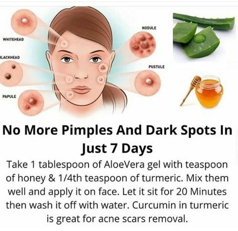 Clear Pimples Overnight, Clear Pimples, To Remove Pimples, Pimple Solution, How To Clear Pimples, Blind Pimple, Remove Pimples, Pimples Under The Skin, Pimples Overnight