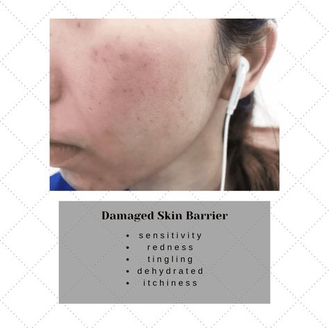 Damaged Skin Barrier, Skin Advice, Skincare Inspiration, Skin Barrier, Skincare Ingredients, Oils For Skin, Dermatology, My Skin, Skin Problems