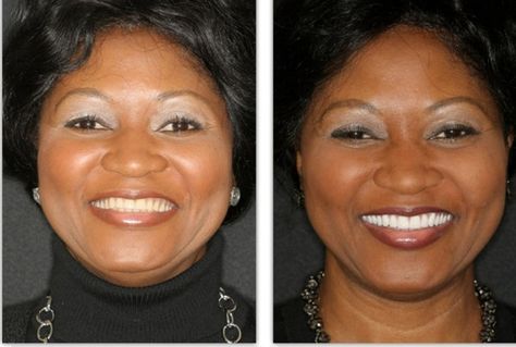 https://www.foydentures.com/before-and-afters/ Dentures Before And After, Dentures Before And After Immediate, Permanent Dentures, Gallery Pictures, Dentures, Critical Thinking Skills, View Pictures, Thinking Skills, Health And Fitness Tips