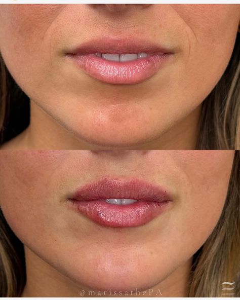 Lip Filler results by Marissa Barrionuevo, PA-C at Velour Medical in NYC Lip Filler Results, Lip Filler, Perfect Lips, Lip Fillers, Lips, Medical, Cute Outfits, Beauty