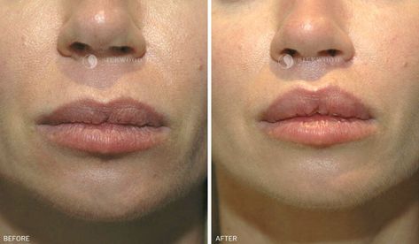 Lip Lift Before And After, Lip Lift Surgery, Upper Lip Lift, Surgery Inspiration, Lip Implants, Lip Surgery, Lip Lift, Lips Inspiration, Upper Lip Hair