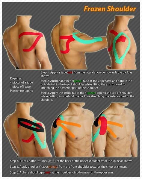 Kinesiology taping instructions for frozen shoulder #ktape #frozenshoulder #ares Shoulder Exercises Physical Therapy, Frozen Shoulder Exercises, Punkty Spustowe, K Tape, Shoulder Rehab, Kinesio Taping, Frozen Shoulder, Frosé, Kinesiology Taping