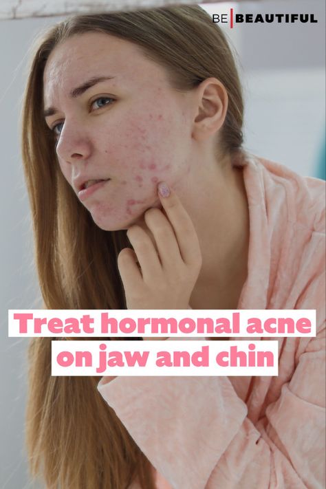 Treating hormonal acne How To Treat Chin Acne, Acne On Chin Meaning, Acne On Jawline Meaning, Treat Hormonal Acne, Jawline Acne, Painful Acne, Acne Reasons, Chin Acne, Hormonal Imbalance