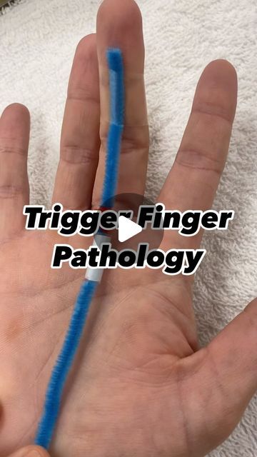 @upper.x.ot on Instagram: "Here’s a clinical picture of what’s happening during a “trigger” in stenosing tenosynovitis.
•
•
It’s important to note what stage of trigger finger the patient is in order to provide the appropriate intervention. Using the Quinell Grading system is helpful in doing so. 
•
•
Proper assessment of the finger is crucial to differentiate between trigger finger, dupuytren’s, and a ganglion cyst as symptoms can overlap. 

#occupationaltherapy #orthohands #ot #outpatientot #occupationaltherapytips  #occupationaltherapist #OTD #Handnugget #occupationaltherapiststudent" Occupational Therapy Activities, Trigger Finger, Grading System, The Patient, Occupational Therapist, Occupational Therapy, Therapy Activities, Acupressure, Assessment