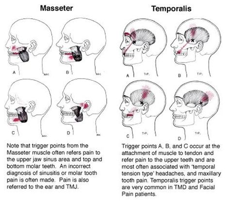 Trigger Points & Referred Pain Patterns in the Masseter & Temporalis muscles Anatomy Trains, Punkty Spustowe, Face Muscles, Massage Training, Referred Pain, Dry Needling, Jaw Pain, Trigger Point Therapy, Relationship Therapy