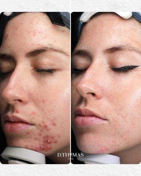 4 months of acne progress 🤍 our client’s skin journey included a combination of our signature laser and non-laser treatments. We are so pleased with these results!! Managing acne means a complete approach—we calm inflammation, control oil, strengthen skin for faster healing and boost the natural bacteria-fighting process to restore clearer, healthier skin.🌤️ #laserskintreatment #acnemanagement #acnebreakouts #acnetreatment #acneprogress #dthomasclinic #debbiethomas Healing Acne, Skin Journey, Healthier Skin, Healing Process, 4 Months, Natural Skin Care, Healthy Skin, Acne, Healing