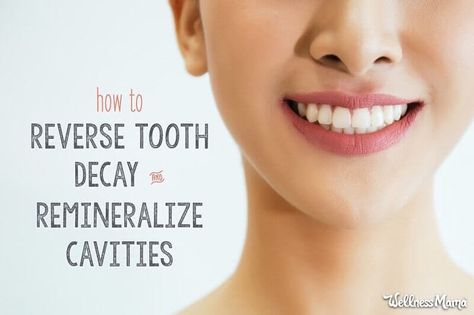 Reverse Tooth Decay, Cavity Remedy, Remineralize Teeth, Remineralizing Toothpaste, Sensitive Teeth Remedy, Heal Cavities, Wellness Mama, Holistic Health Remedies, Teeth Health