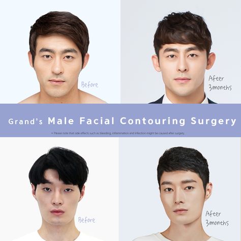 Contour For Men, Plastic Surgery Korea, Facial Surgery, Face Contour, Facial Contouring, Reconstructive Surgery, Face Contouring, Makeup Artists, Free Consultation