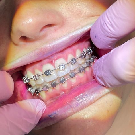 Do you have a #teen with #braces? Here are a few #tips... ✔ Use disclosing tablets to help improve brushing. ✔ Pull lips and cheeks back to allow the toothbrush to angle better underneath and on top of the brackets. ✔ Use a song as a timer for how long they should be brushing each time. #bracestips #valdostaorthodontist #hestermorris Disclosing Tablets, Adult Braces, Braces Tips, A Teen, Brushing, A Song, Braces, Brushing Teeth, Tablet