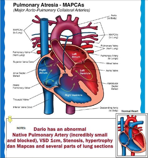 His Rare Case of CHD : Tetralogy of Fallot (ToF) with PA and MAPCAs Tetralogy Of Fallot, Chd Warrior, Anatomy 101, Cardiac Sonography, Atrial Septal Defect, Congenital Heart Defect Awareness, Tricuspid Valve, Radiology Student, Diagnostic Medical Sonography