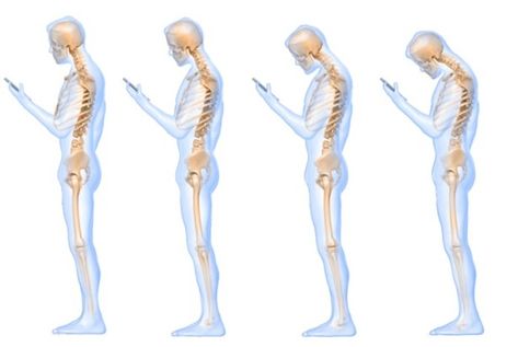 A new study suggests that looking down at a cell phone is the equivalent of placing a 60-pound weight on one's neck. Healthier Me, Corp Perfect, Text Neck, Alexander Technique, Cervical Spondylosis, Tech Neck, Spine Health, Psoas Muscle, Chronic Migraines