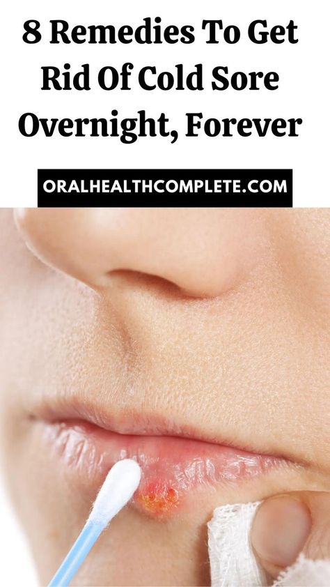 8 Remedies To Get Rid Of Cold Sore Overnight, Forever Cold Sores Remedies Overnight, How To Get Rid Of Cold Sores, How To Get Rid Of Cold Sores Overnight, Cold Sore Scab, Cold Sore Remedy Overnight, Fever Blister Remedy, Blister Remedies, Home Remedies For Cold, Cold Sore Relief