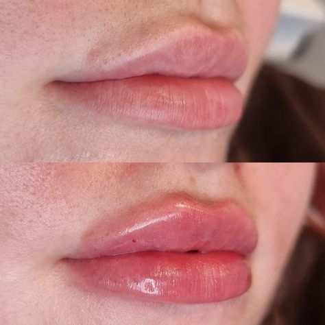 Lip Filler 0.5ml, Bad Lip Filler, 0.5ml Lip Filler Before And After, Lip Fillers Before And After 1ml, 0.5 Ml Lip Filler Before And After, Russian Lips, Spa Aesthetic, Revolution Beauty, Lip Permanent Makeup