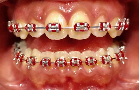 Maroon Braces Teeth, Red Braces Teeth, Red Braces Aesthetic, Maroon Braces, Perfect Teeth Braces, Dental Braces Colors, Braces Ideas, Red Braces, Braces Rubber Bands