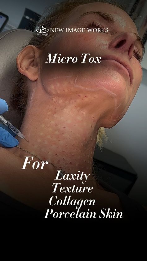 Lips-Filler-Botox-Lasers Chicago | Micro Tox is a technique of placing Botox or other type of neurotoxin very superficial in tiny droplets to the upper dermis. It helps to... | Instagram Medspa Office, Botox Mapping, Botox Units, Botox Injection Sites, Injection Sites, Botox Injection, Botox Lips, Porcelain Skin, Lip Blush