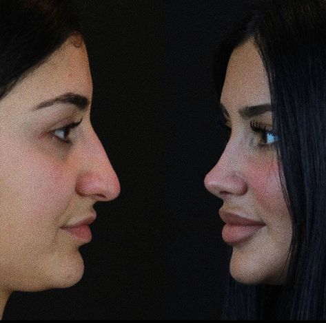 Nose Surgery Rhinoplasty, Rhinoplasty Nose Jobs, Job Inspiration, Pretty Nose, Facial Surgery, Perfect Nose, Facial Fillers, Facial Contouring, Small Nose