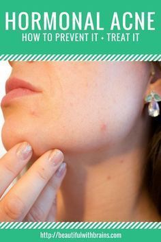 Do you always get pimples on your chin and jawline during your period? As your hormones fluctuate a week before you're due, your skin becomes oilier and more prone to pimples. Fear not. A few tweaks to your skincare routine and diet can make those pimples disappear for good. Click through to find out how I got rid of my hormonal acne. #diypimpletreatment Cystic Acne On Chin, Cheek Acne, Chin Acne, Acne Overnight, Skin Care Routine For 20s, How To Get Rid Of Pimples, Acne Causes, Hormonal Acne, Cystic Acne