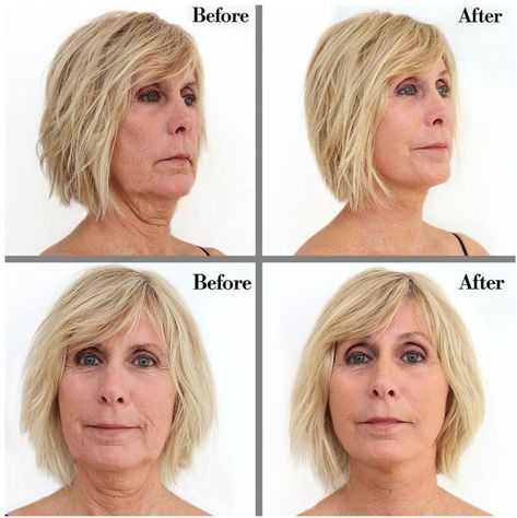 Tighten Your Jawline With Bring It up Instant Neck Lift I - Etsy Haircuts For Fat Faces And Double Chins, Neck Lift Surgery, Neck Tightening, Sagging Neck, Instant Face Lift, Eye Skin Care, Neck Exercises, Celebrity Plastic Surgery, Neck Wrinkles