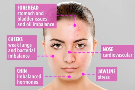 Pimples On Face Meaning, Acne Reasons, Pimple Solution, Pimples On Forehead, Forehead Acne, Natural Oils For Skin, Prevent Pimples, Pimples On Face, Face Mapping