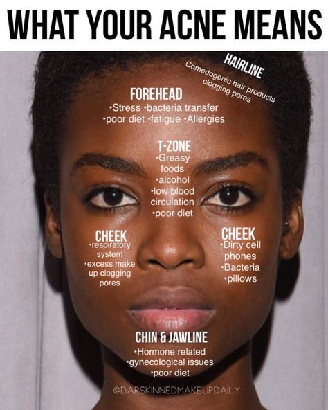 @_okoro • Instagram photos and videos How To Clear Cheek Acne, How To Clear Chin Acne, Pimple Chart, Bumps On Chin, Cheek Breakouts, Chin Breakouts, Jawline Acne, Cheek Acne, Good Jawline