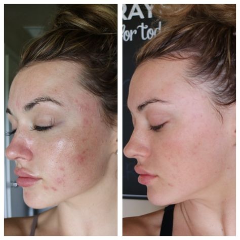 Before(left) & 5 days After (right) Microneedling with PRP. Prp Before And After, Before And After Microneedling, Prp Microneedling Before And After, Prp Face Before And After, Microneedling Before And After, Beautiful Skin Face, Before And After Acne, Acne Prone Skin Care Routine, Clear Skin Diet