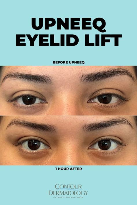 Eyelid Lift, Facial Aesthetics, Upper Eyelid, Rancho Mirage, Surgery Center, Eye Drops, Cosmetic Surgery, Dermatology, To Speak