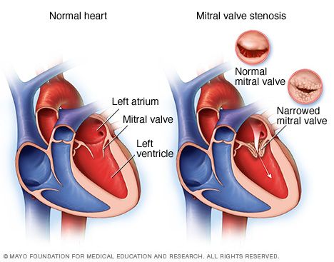 Normal heart and heart with mitral valve stenosis Mitral Valve Regurgitation, Aortic Valve Replacement, Mitral Valve, Heal Thyself, Penyakit Jantung, Heart Valves, Normal Heart, Open Heart Surgery, Disease Symptoms