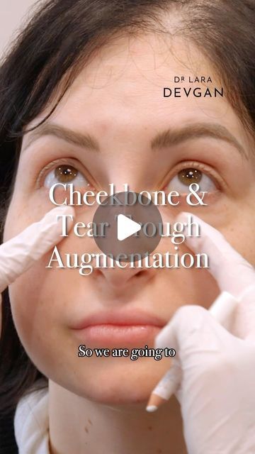 Dr. Lara Devgan, MD, MPH, FACS on Instagram: "The cheekbone is a beautiful area to create a little bit of structure and smoothness in the lid cheek junction. The tear trough is a key area to maintaining a fresh and awake look. Through my signature nonsurgical #facialoptimization, I use hyaluronic acid based filler to subtly replenish the face for a natural appearance. 

#devganoptimization #plasticsurgery #plasticsurgeon #beautyisinthedetails" Tear Trough Remedy Natural, Cheekbone Filler Before And After, Tear Trough Filler Before After, Cheek Fillers Before And After Face, Tear Trough Filler, Tear Trough, Cheek Fillers, My Signature, Plastic Surgeon