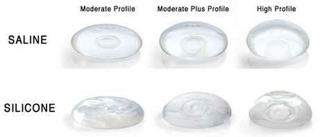 Breast Implants: Saline vs Silicone https://plus.google.com/112112855647092613112 #miami #plasticsurgery #breast Contact Dr. Tal Roudner 305-443-3531 Saline Implants, Silicone Implants, Natural Breast Enlargement, Facial Contouring, Celebrity Plastic Surgery, Mommy Makeover, Breast Reduction, Breast Surgery, Which Is Better