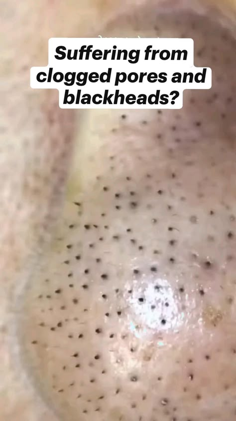 clear your blackheads instantly with these blackhead remover. get a clear skin instantly. these blackhead strippers give you a clear skin by squeezing the blackheads out of your face.  #blackheads  #clearskintips #skincare #clearskinproducts #clearskingoals Blackhead Removal Diy, Clean Pores Videos, Indian Spices List, Spices List, Blackhead Removal Mask, Get Rid Of Scars, Blackhead Removal Tool, Nose Pimples, Squeezing Blackheads