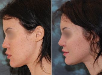 Rhinoplasty & Nasal Surgery Los Angeles, CA - Rhinoplasty & Nose Surgery Nose Rhinoplasty, Nasal Septum, Nose Picking, Best Plastic Surgeons, Neck Surgery, Nose Surgery, Reconstructive Surgery, Facial Plastic, Cosmetic Procedures