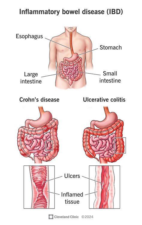 What Is Inflammatory Bowel Disease (IBD)? Ibd Symptoms, Gastrointestinal Tract, Inflammatory Bowel, Poor Nutrition, Disease Symptoms, Stomach Problems, Cleveland Clinic, Large Intestine, Scar Tissue