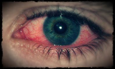 What does pink eye (conjunctivitis) look like? Conjuctivita Eye, Pink Eye, Pink Eyes, Disease, Conditioner, Education, Pink, Quick Saves