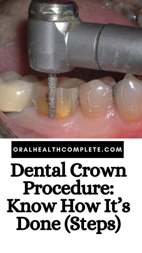 Dental Crown Procedure