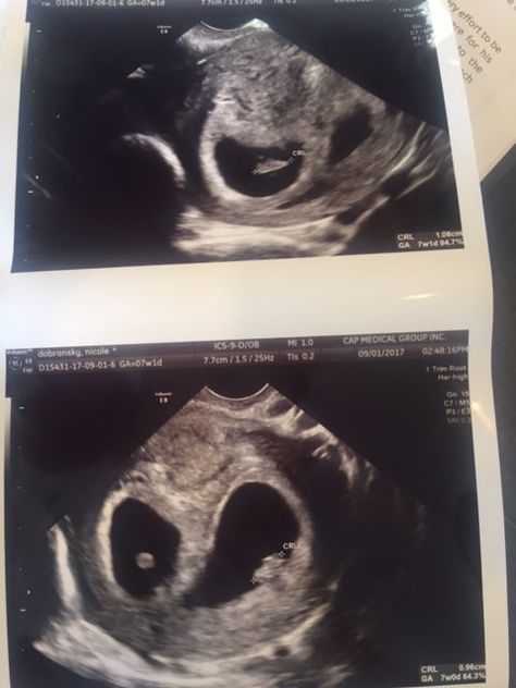 Finding Out We're Having Twins (And How It's Different) - Fitness Fatale Twins Ultrasound Aesthetic, Twin Ultrasound, Twins Ultrasound, Baby Ultrasound Pictures, Couple Shadow, Having Twins, Singer Dr, Mom Dr, Baby Ultrasound