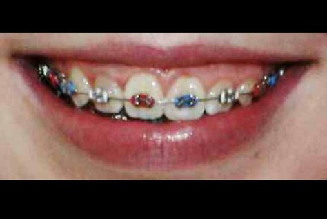 red white and blue braces Red And Blue Braces, Blue Braces, Red Braces, Braces Ideas, Braces Smile, Braces Tips, Cute Braces, Braces Colors, Free Consultation