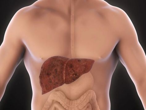 Home Remedies for an Enlarged Liver. An enlarged liver, or hepatomegaly, is a condition that presents with very few symptoms during the initial stage of inflammation. This makes the tas... Quadrants Of The Abdomen, Enlarged Liver, Liver Recipes, Viral Infection, Serious Illness, Body Organs, Toning Workouts, Loose Skin, Veggie Recipes