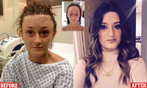 Woman bullied for large forehead got £6,500 surgery to make it smaller High Forehead Bangs, Hairstyles High Forehead, Haircut For Large Forehead For Women, How To Hide Big Forehead, Hairstyles For Large Foreheads For Women, Bangs For High Forehead, Large Forehead Hairstyles For Women, How To Make Your Forehead Smaller, Small Forehead Fringe