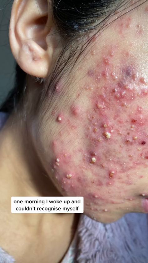 Inspirational Acne Journey Quotes to Motivate You How To Prevent Blackheads, Quotes About Overcoming, Acne Journey, Clear Acne Fast, Causes Of Acne, Mild Acne, Minimalist Skincare, Quotes To Motivate, Skincare Inspiration