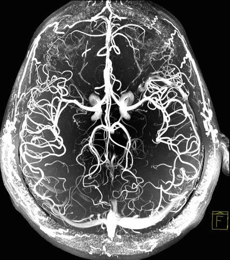 Blood vessels of the human brain shown via Magnetic Resonance Angiography at 7T #MRI Image by Dr. Jon Polimeni, #MGH Structure Of The Brain, Brain Neurons Art, Neurosurgery Art, Neurons Art, Brain Medicine, Anatomical Brain, Brain Neurons, Brain Images, Brain Scan